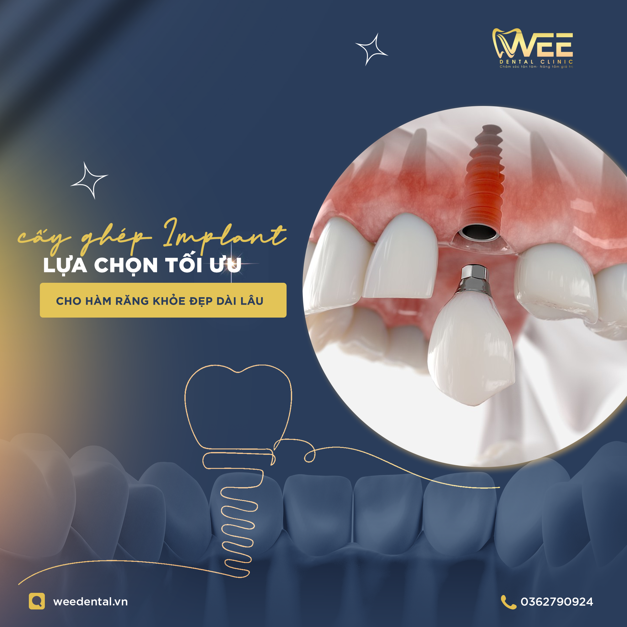 CẤY GHÉP IMPLANT