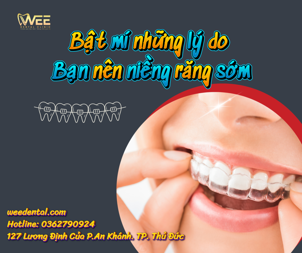Niềng răng
