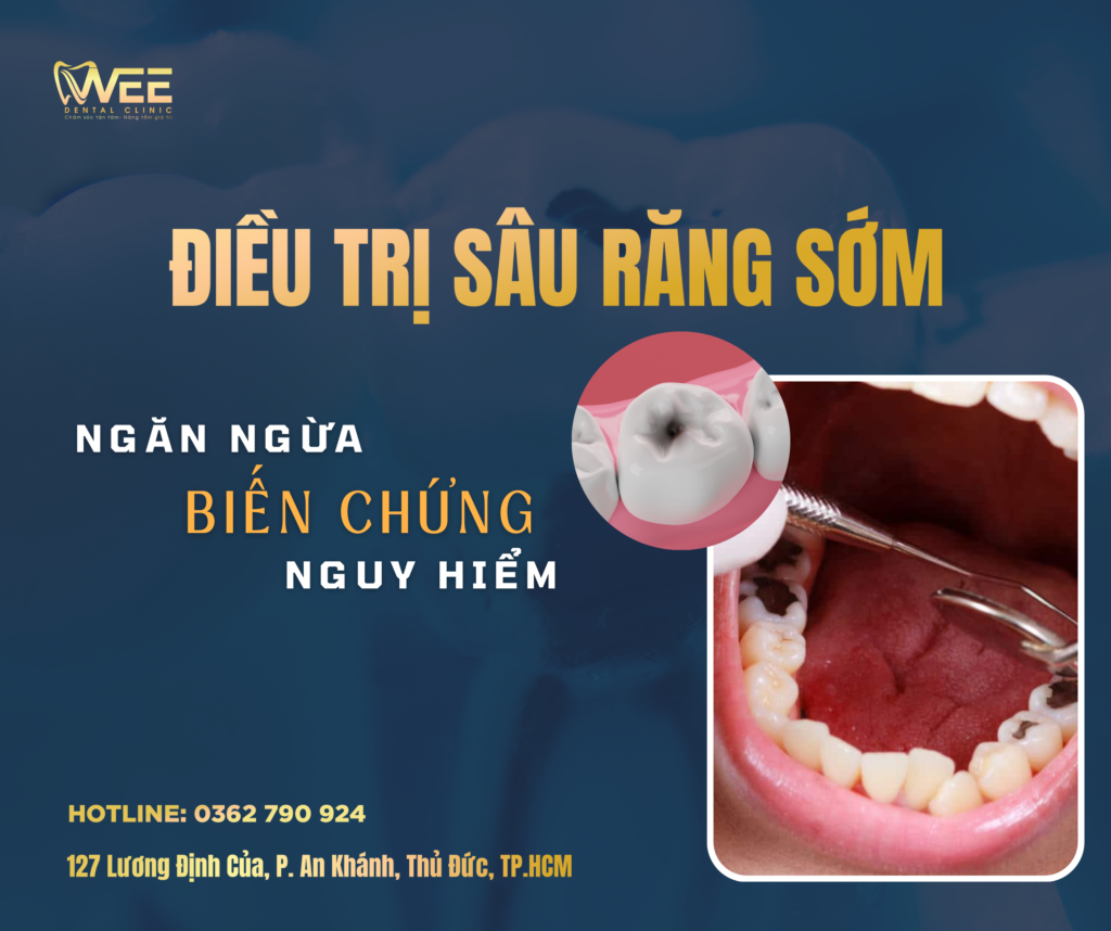 ĐIỀU TRỊ SÂU RĂNG