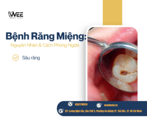 Bệnh răng miệng