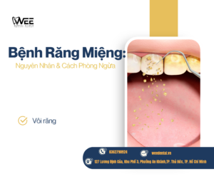 Bệnh răng miệng