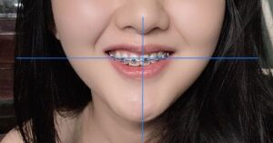niềng răng giá rẻ có an toàn không