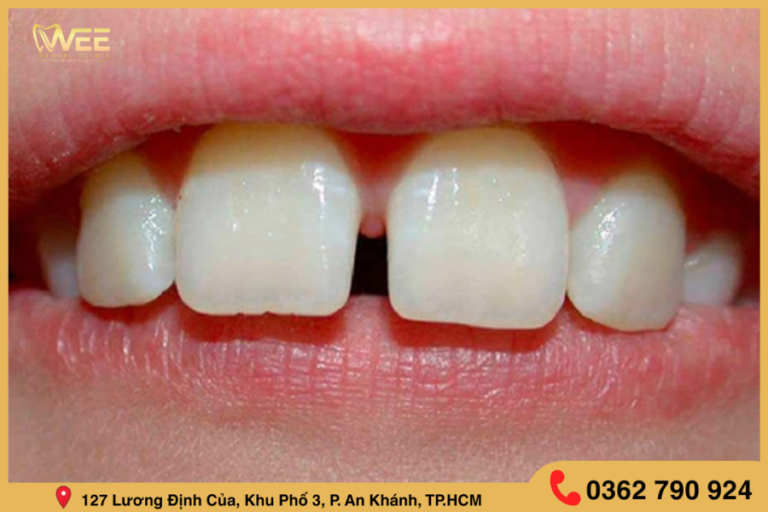 điều trị răng thưa