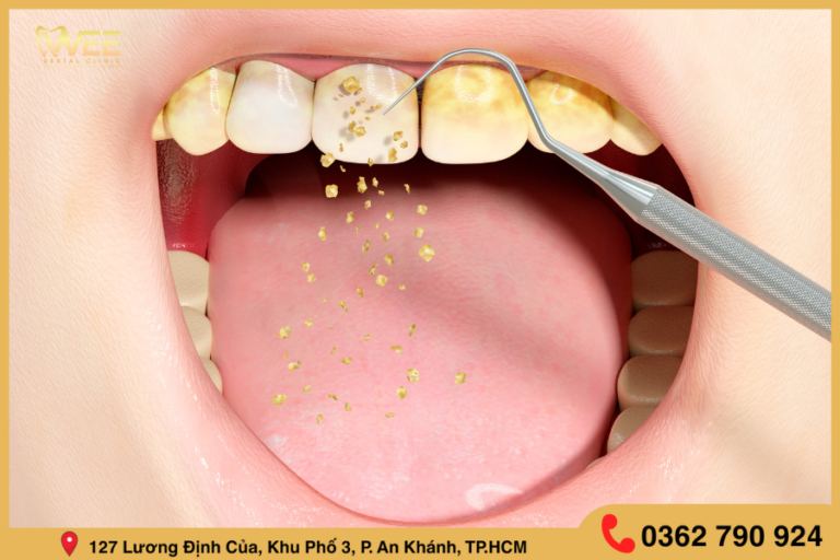 cạo vôi răng trị hôi miệng