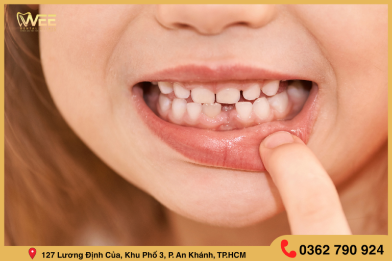 những cách tạm biệt răng thưa