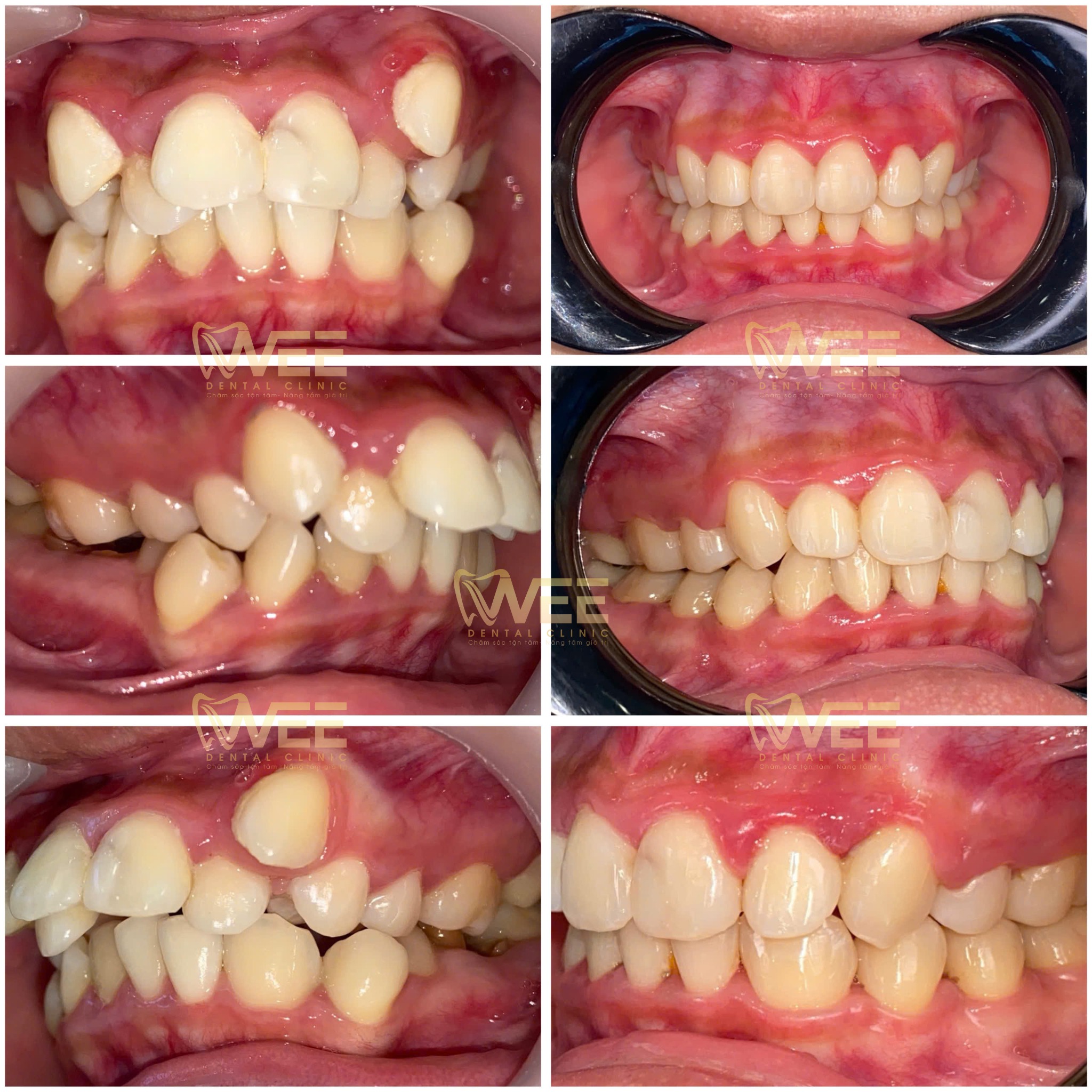 hiệu quả niềng răng tuổi teen