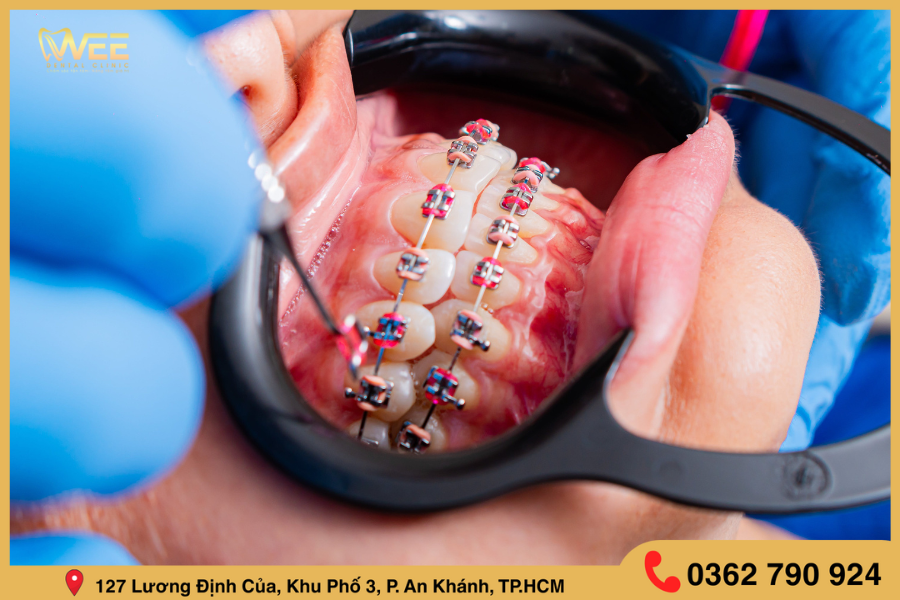niềng răng 5 triệu