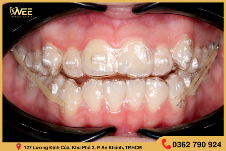 niềng răng trong suốt Invisalign