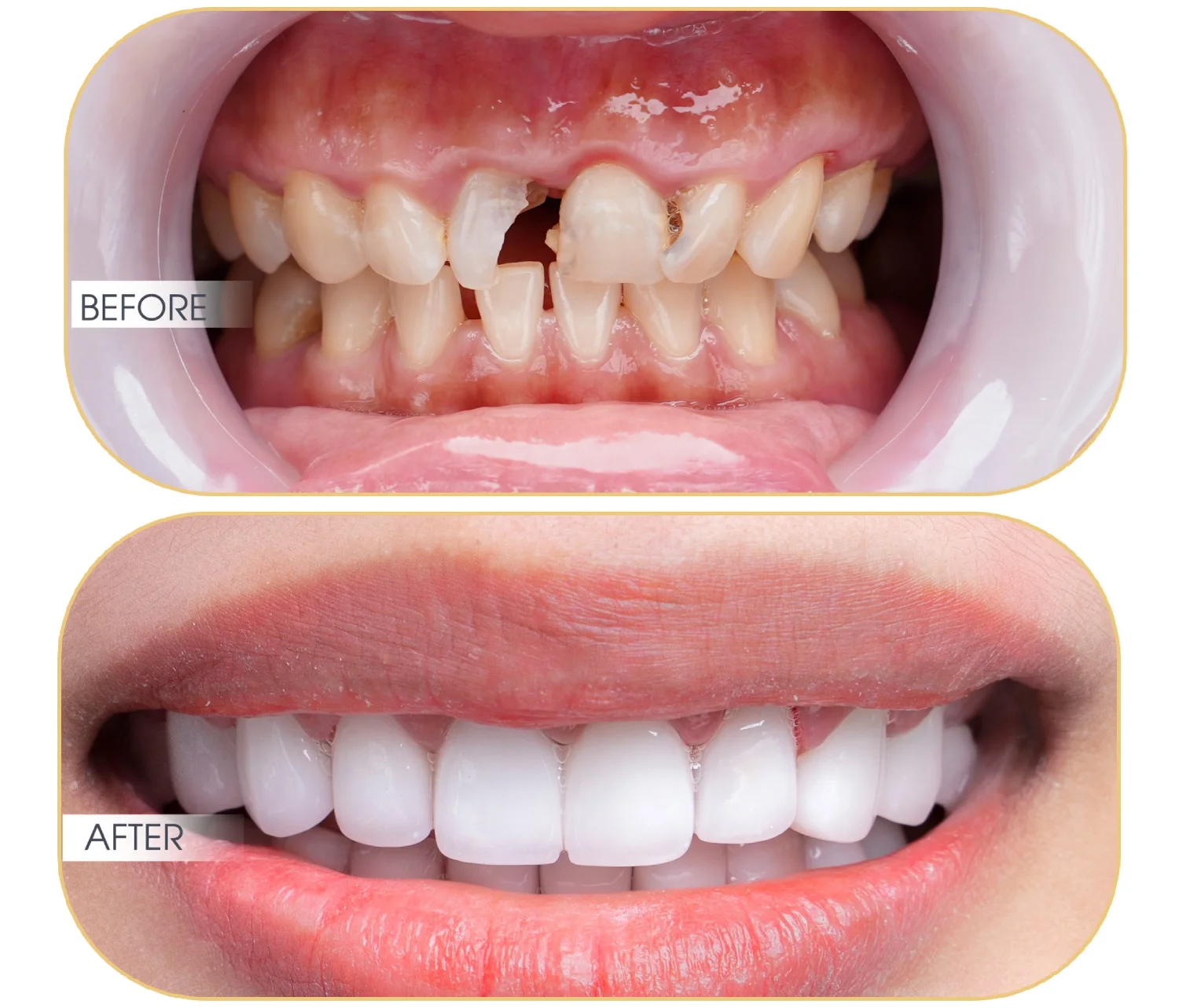 thẩm mỹ răng sứ