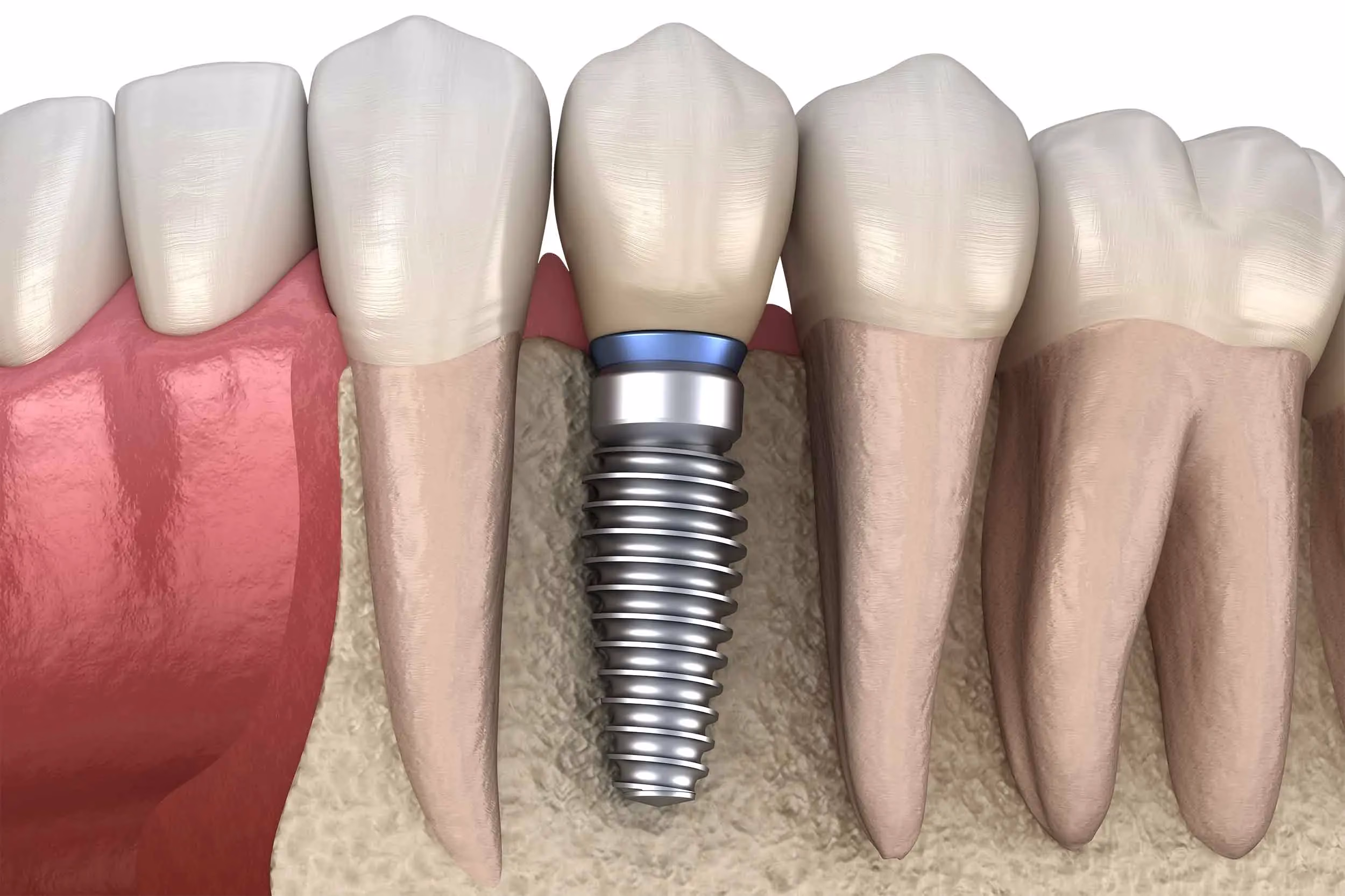 NHA-KHOA-WEE-implant