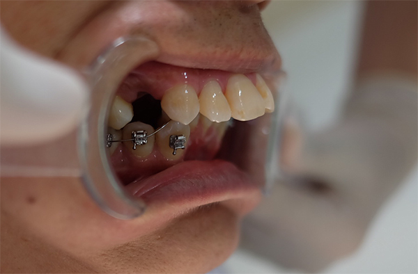 nhổ răng chỉnh nha