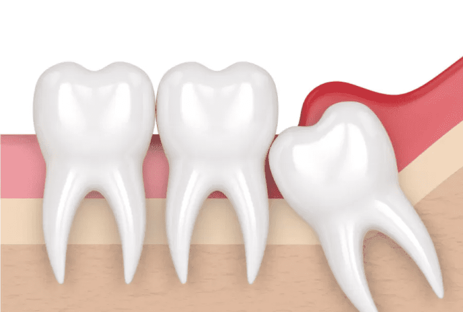 răng khôn mọc lệch