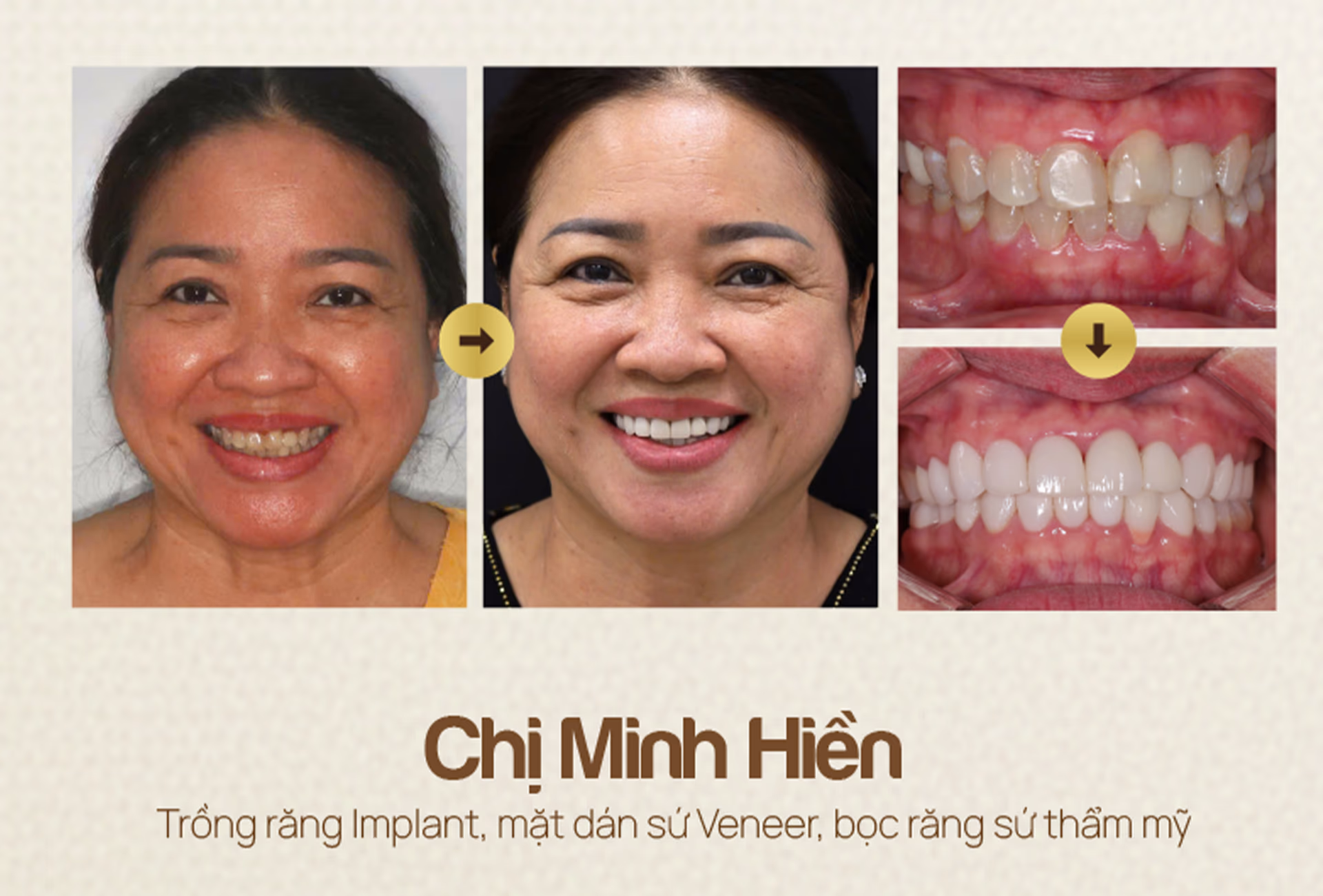 nha-khoa-wee-dieu-tri-truoc-va-sau