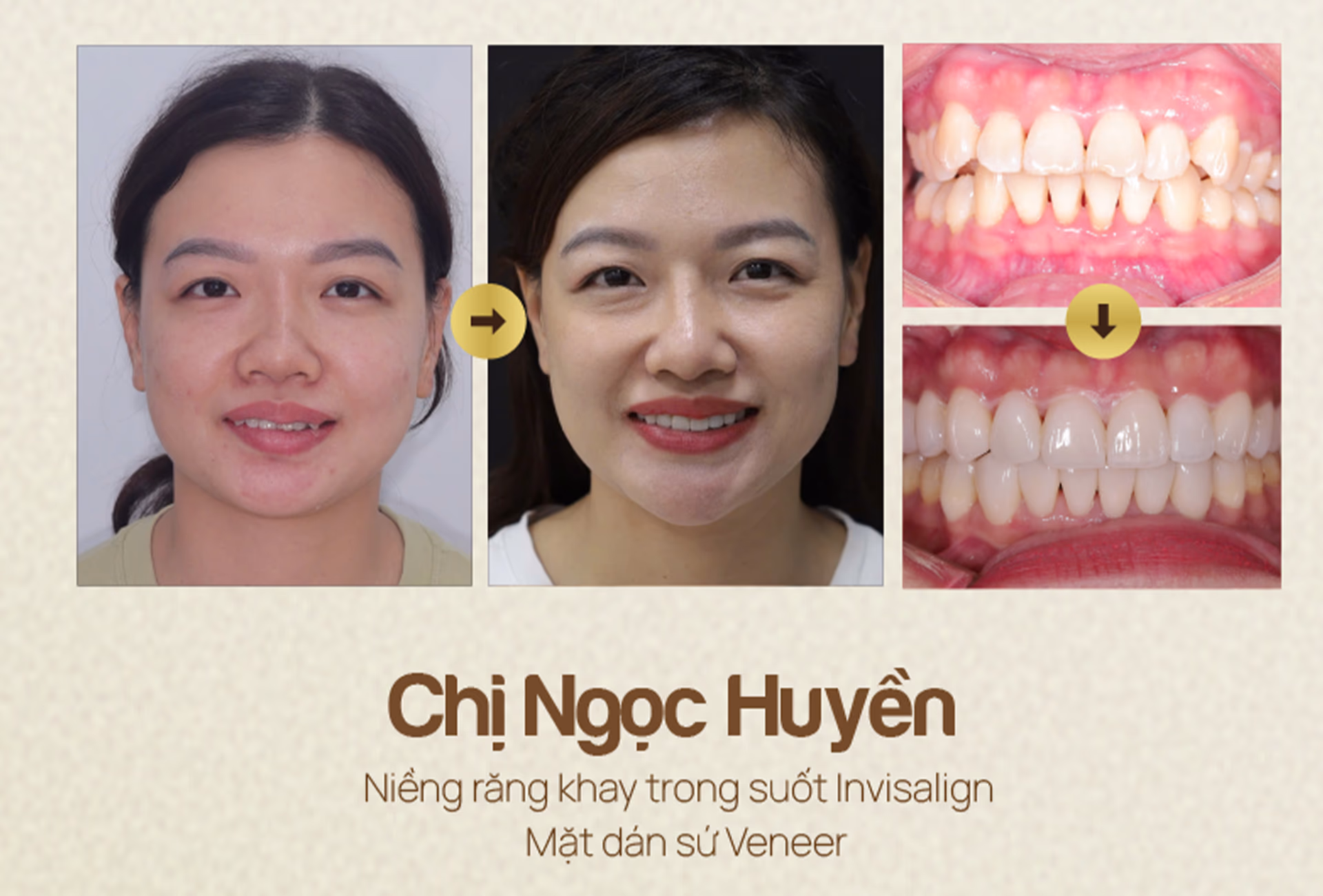 nha-khoa-wee-dieu-tri-truoc-va-sau