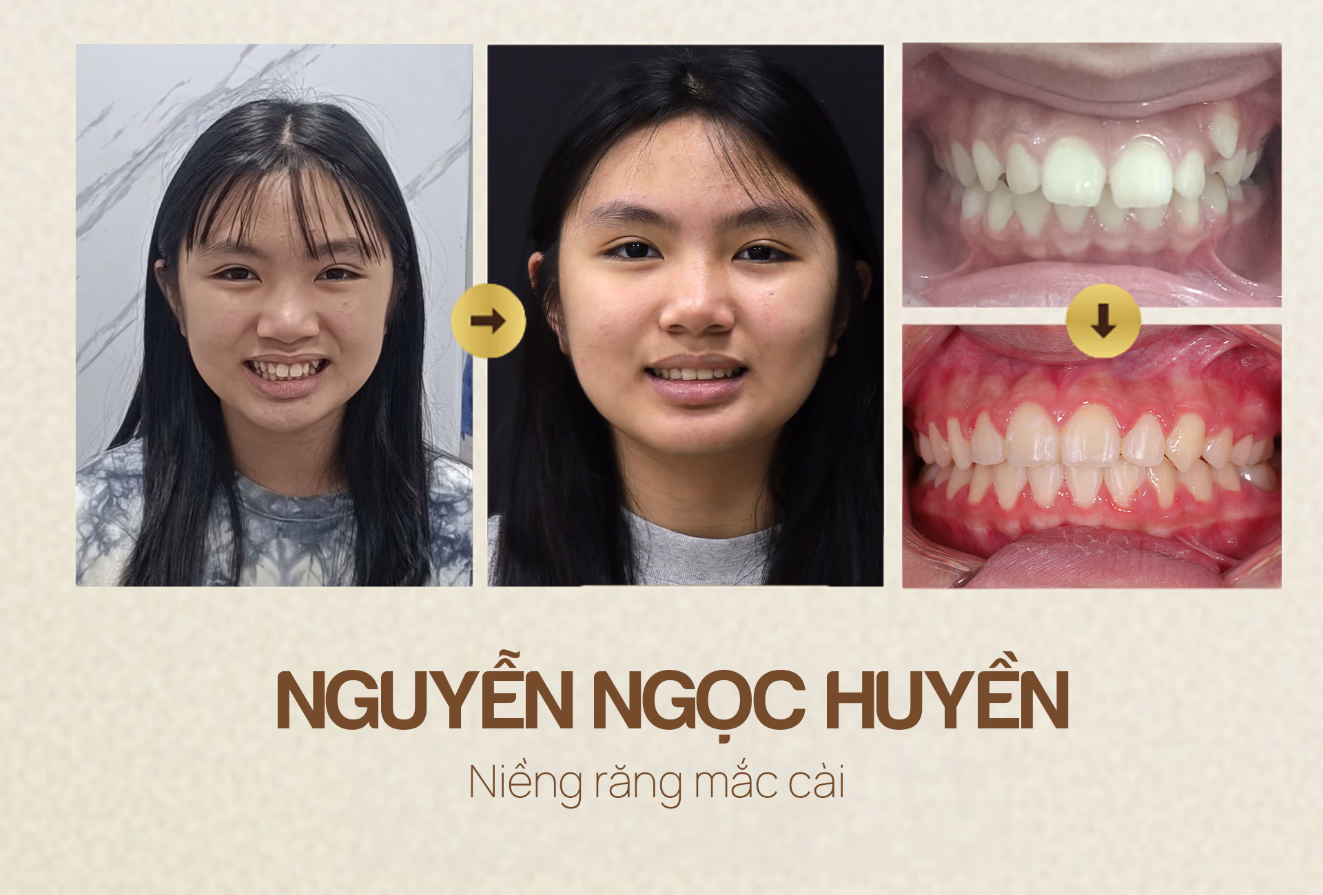 nha-khoa-wee-dieu-tri-truoc-va-sau