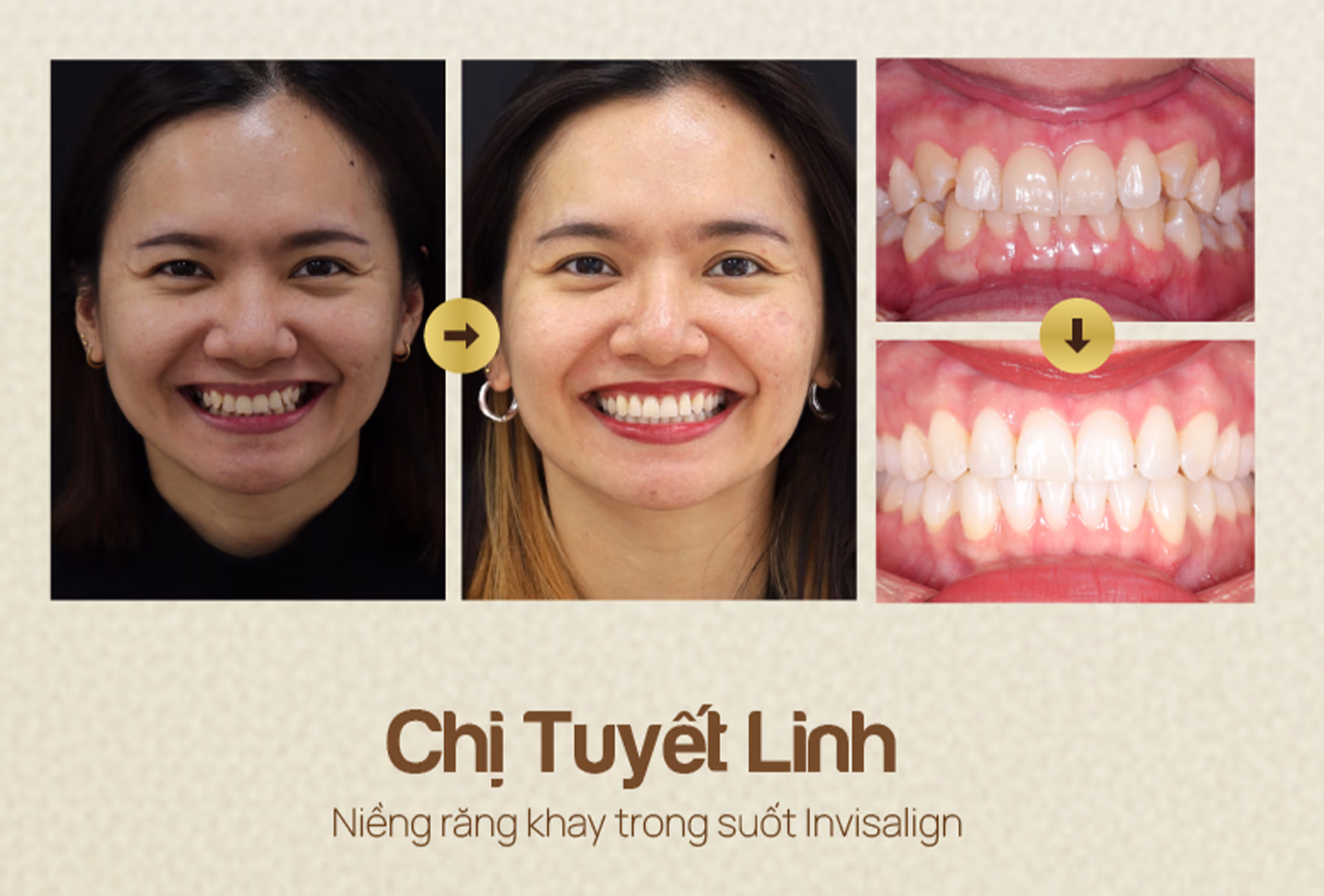 nha-khoa-wee-dieu-tri-truoc-va-sau