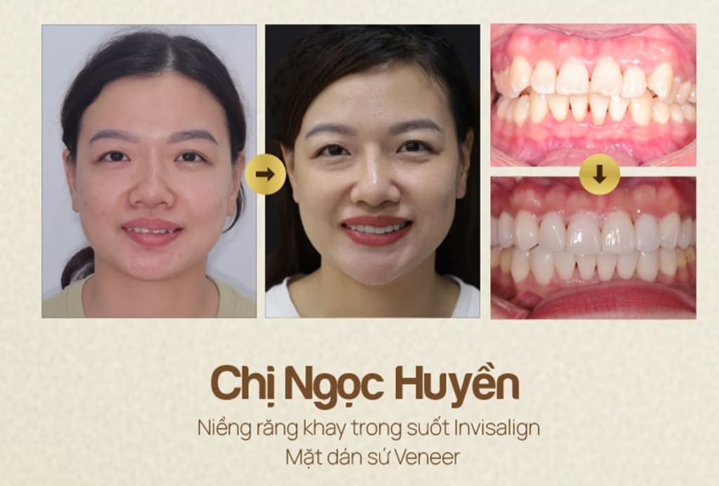 Sau điều trị, Chị Ngọc Huyền đã tự tin hơn về nụ cười của mình