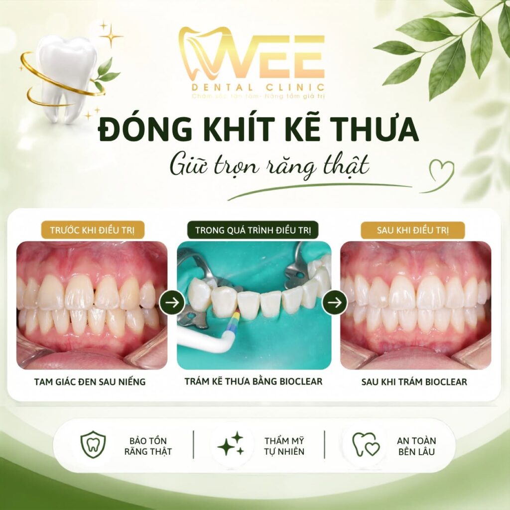 Kết quả sau khi trám kẽ răng thưa sau khi niềng của khách Chiêu A.