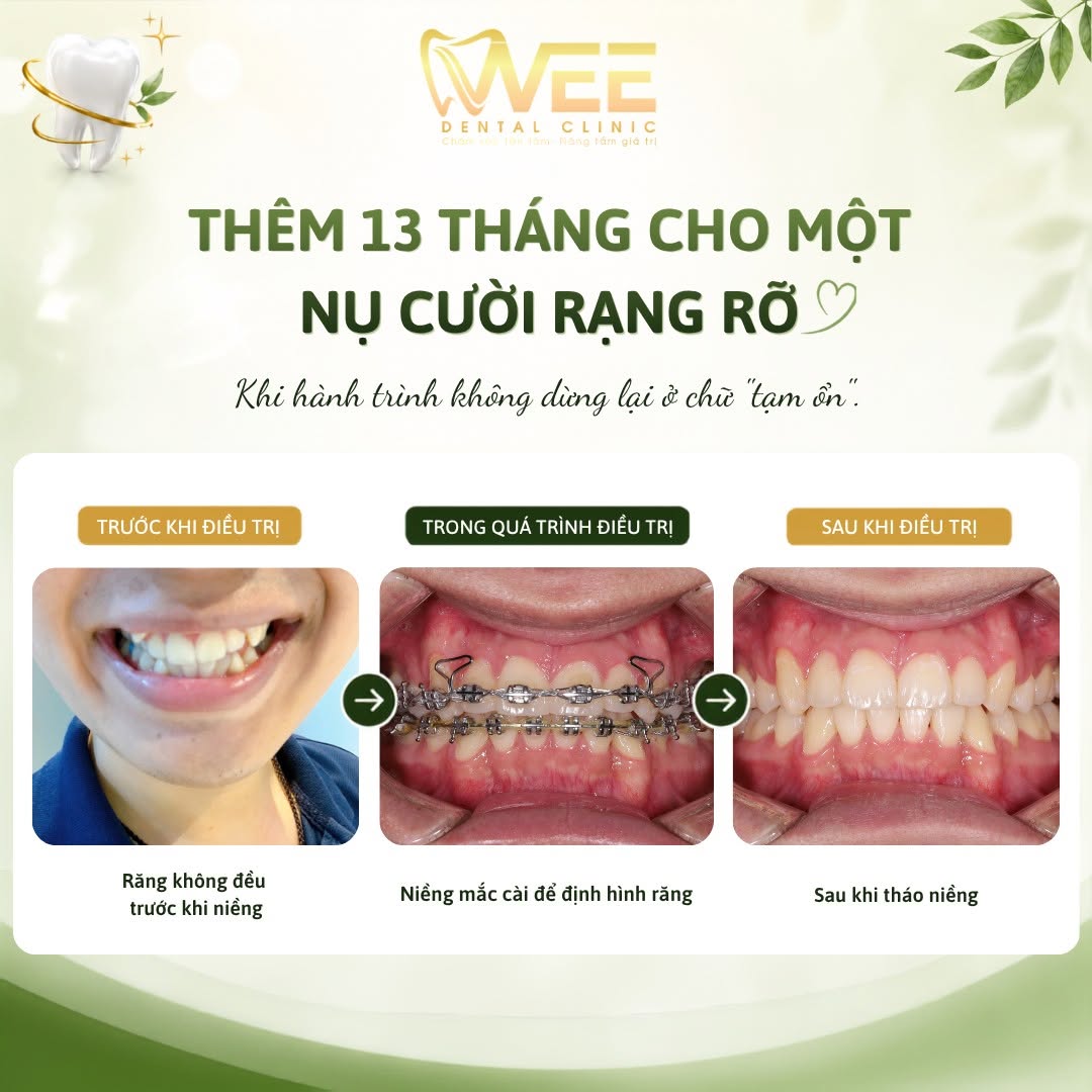 Hoàng Nguyễn niềng răng tại nha khoa WEE