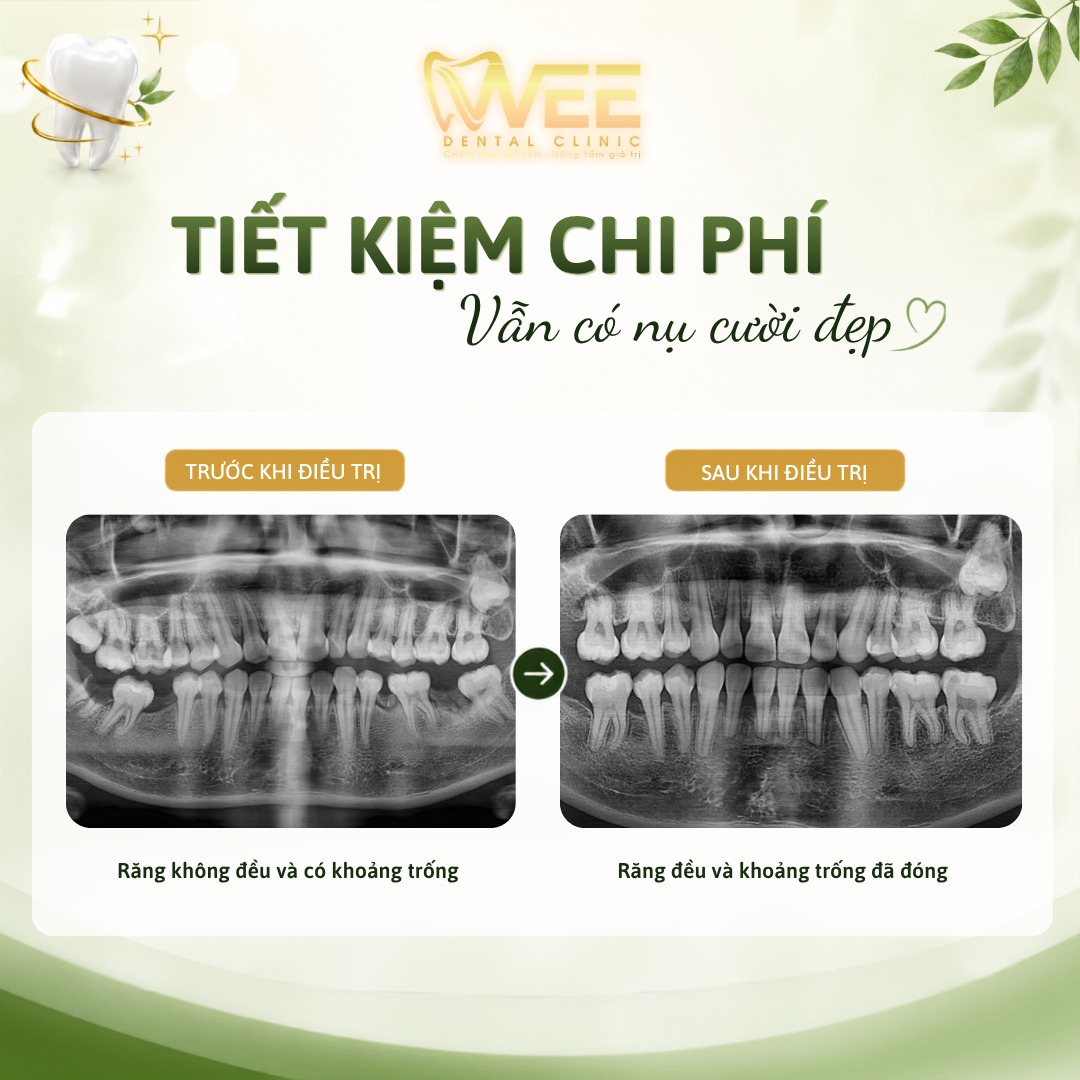 Hình răng KH Thảo đã làm răng tại nha khoa WEE